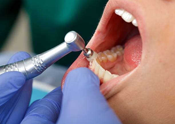 Dental Bonding in Golden Triangle, NJ